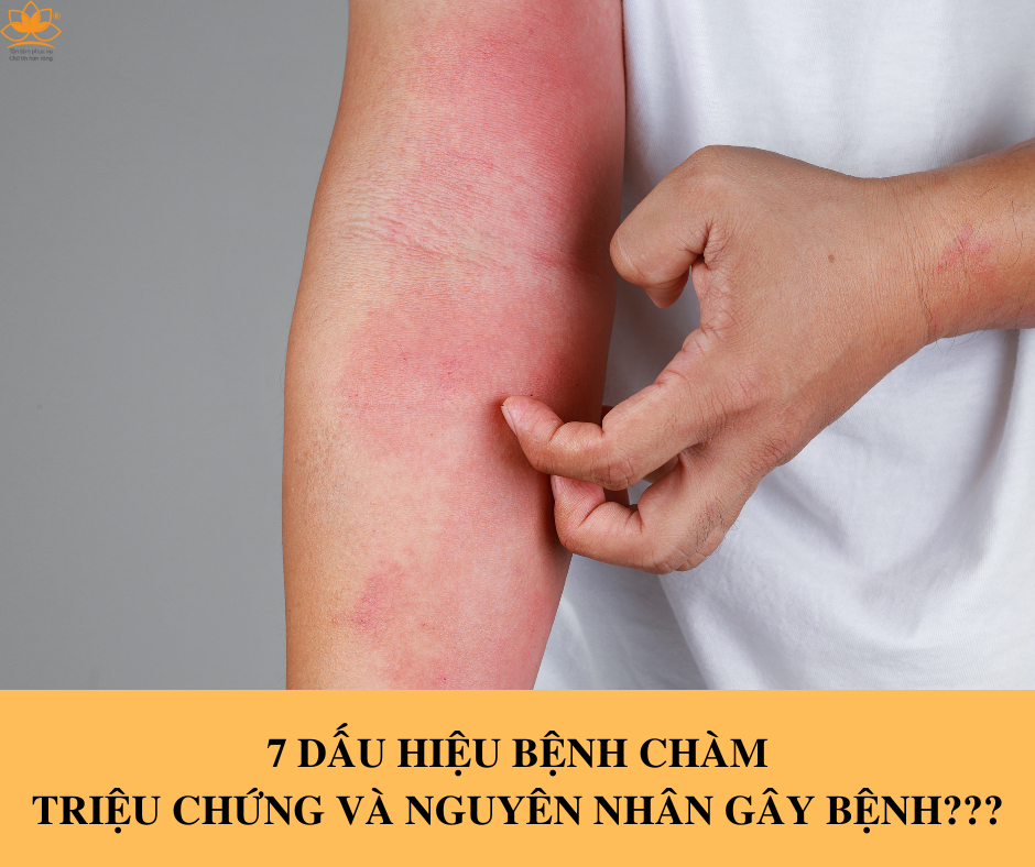 7 LOẠI BỆNH CHÀM: TRIỆU CHỨNG VÀ NGUYÊN NHÂN